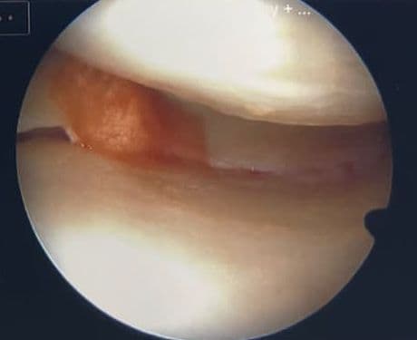Arthroscopic view during cartilage assessment